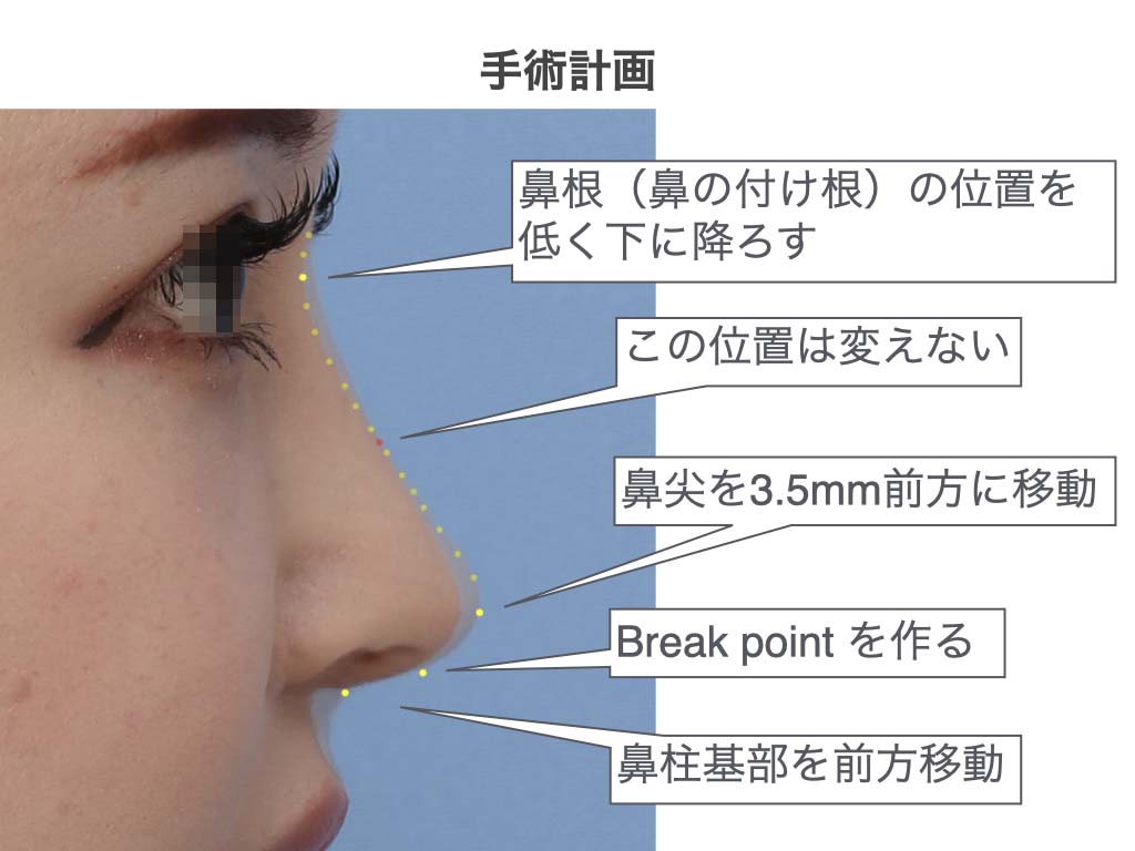鼻付け根裂ける: 60代 鼻の横が裂ける – VBSAL