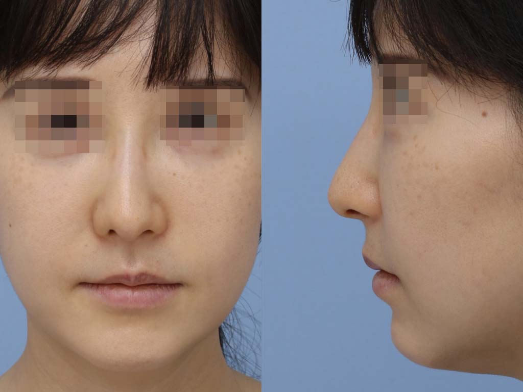 症例写真,上口唇リフト（人中短縮、リップリフト）で長い鼻の下を短くした症例写真