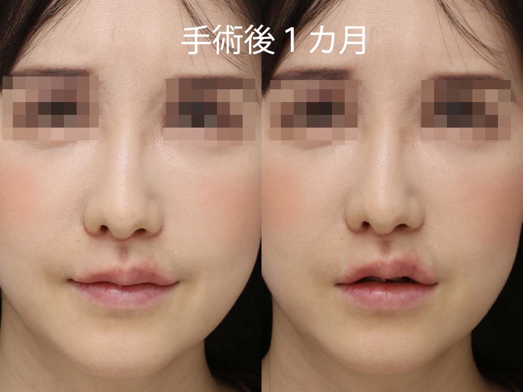 症例写真,上口唇リフト（人中短縮、リップリフト）で長い鼻の下を短くした症例写真