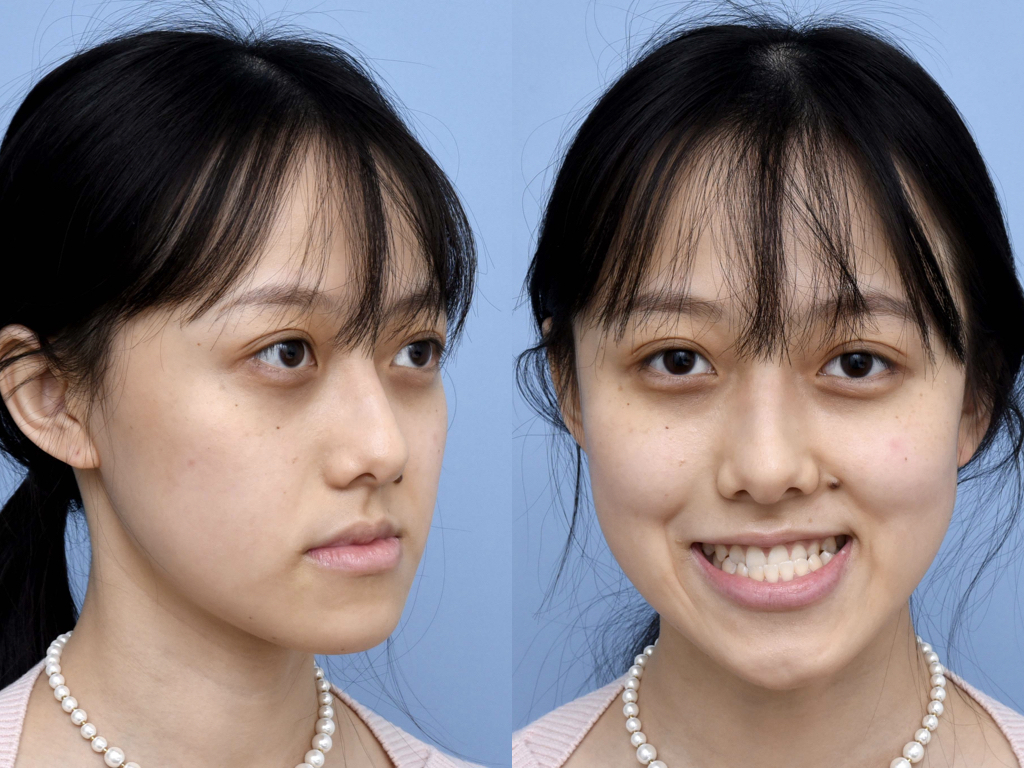 両顎手術の回復タイムライン