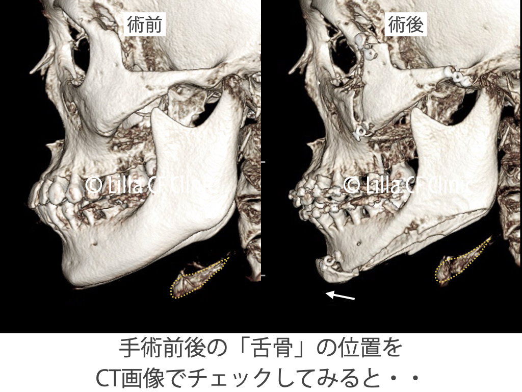 舌骨の移動