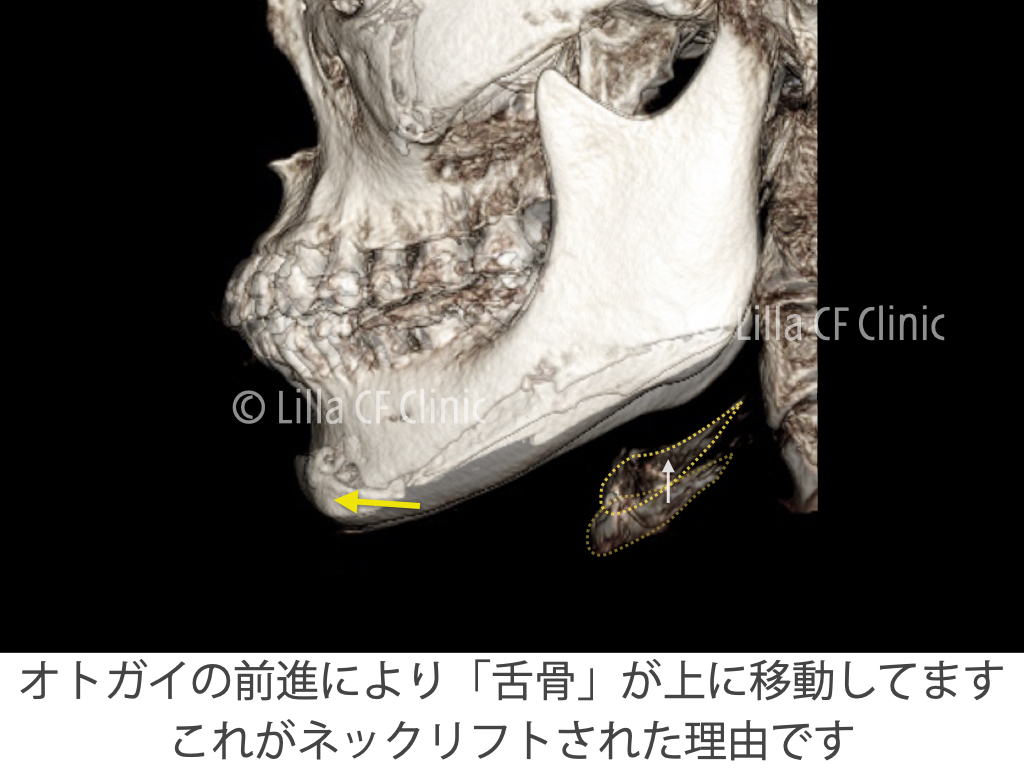 舌骨の移動