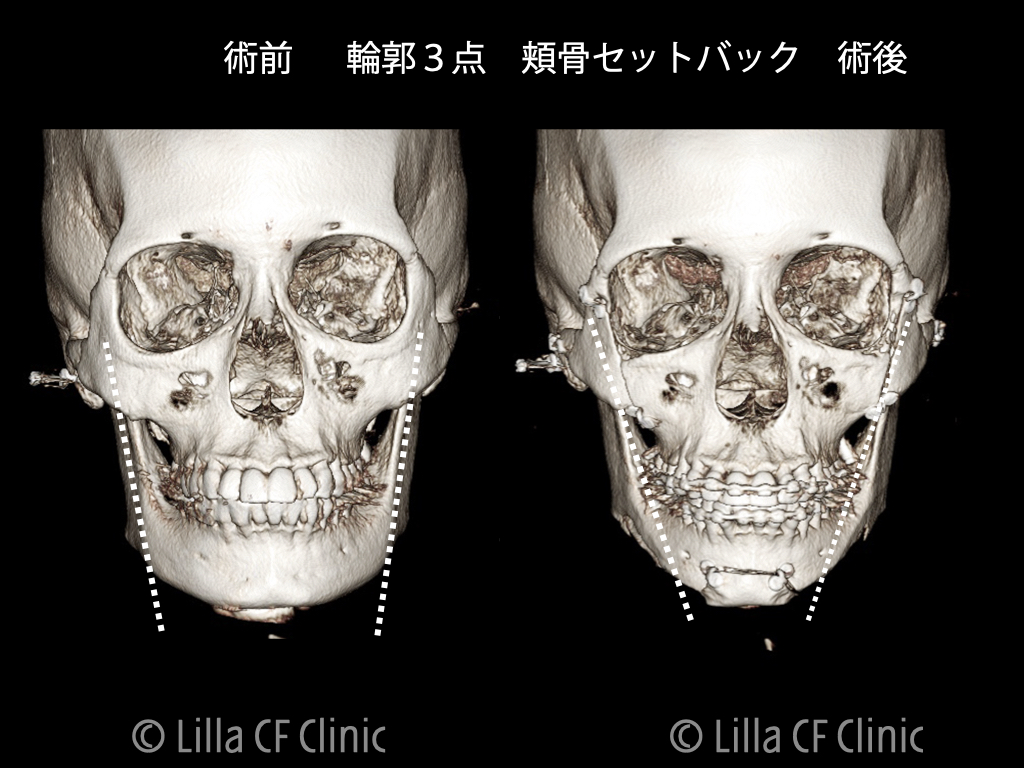 zygoma setback osteotomy