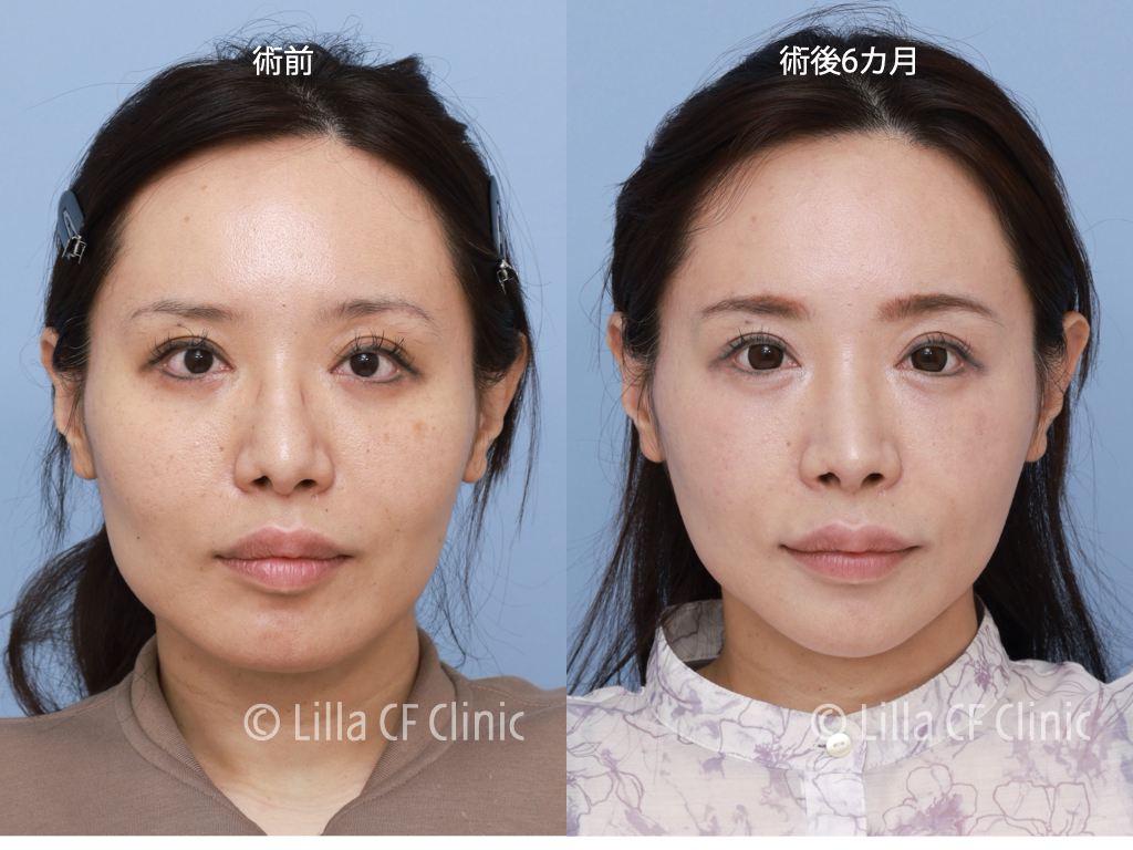 頬骨セットバック,眼窩縁削り,輪郭4点