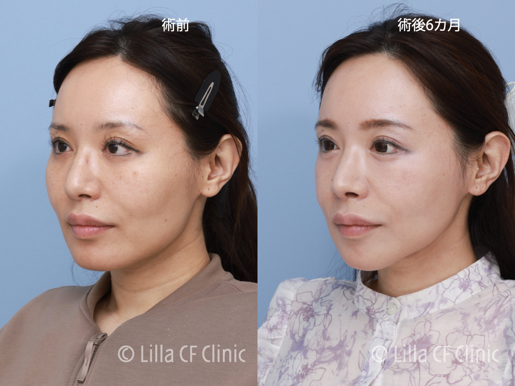 頬骨セットバック,眼窩縁削り,輪郭4点