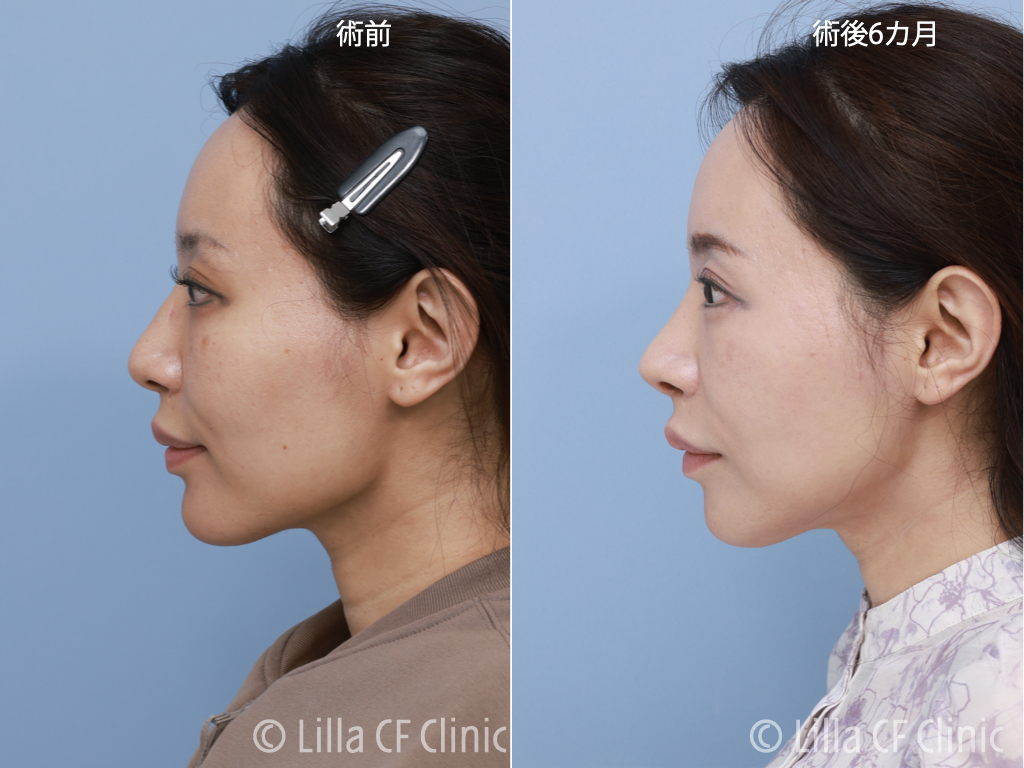 頬骨セットバック,眼窩縁削り,輪郭4点