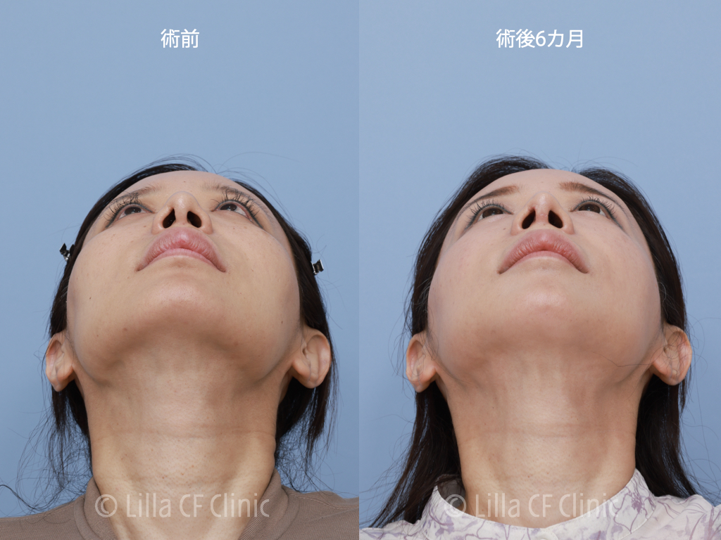 頬骨セットバック,眼窩縁削り,輪郭4点