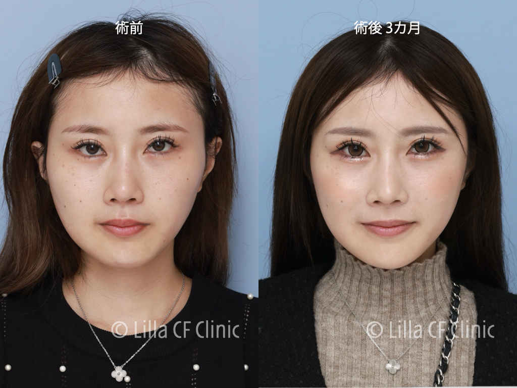 頬骨セットバックで輪郭をやさしくした症例,オージーカーブ