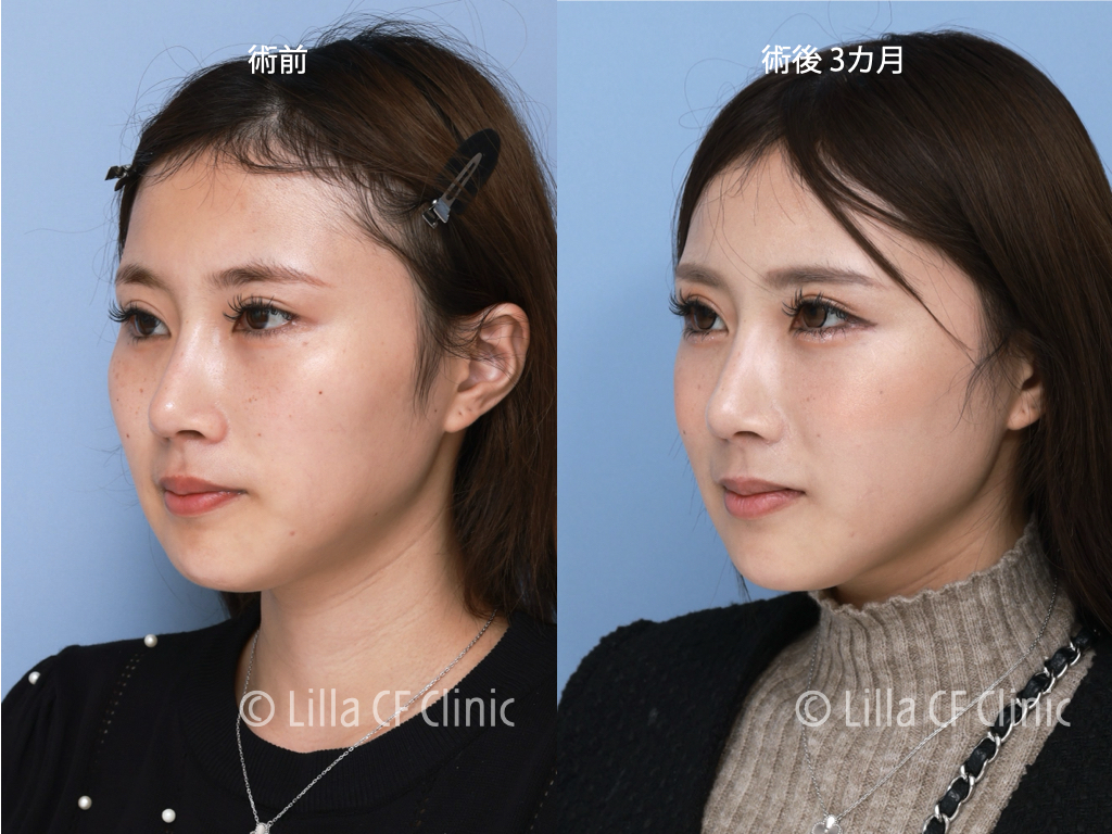 頬骨セットバックで目を大きくした症例,