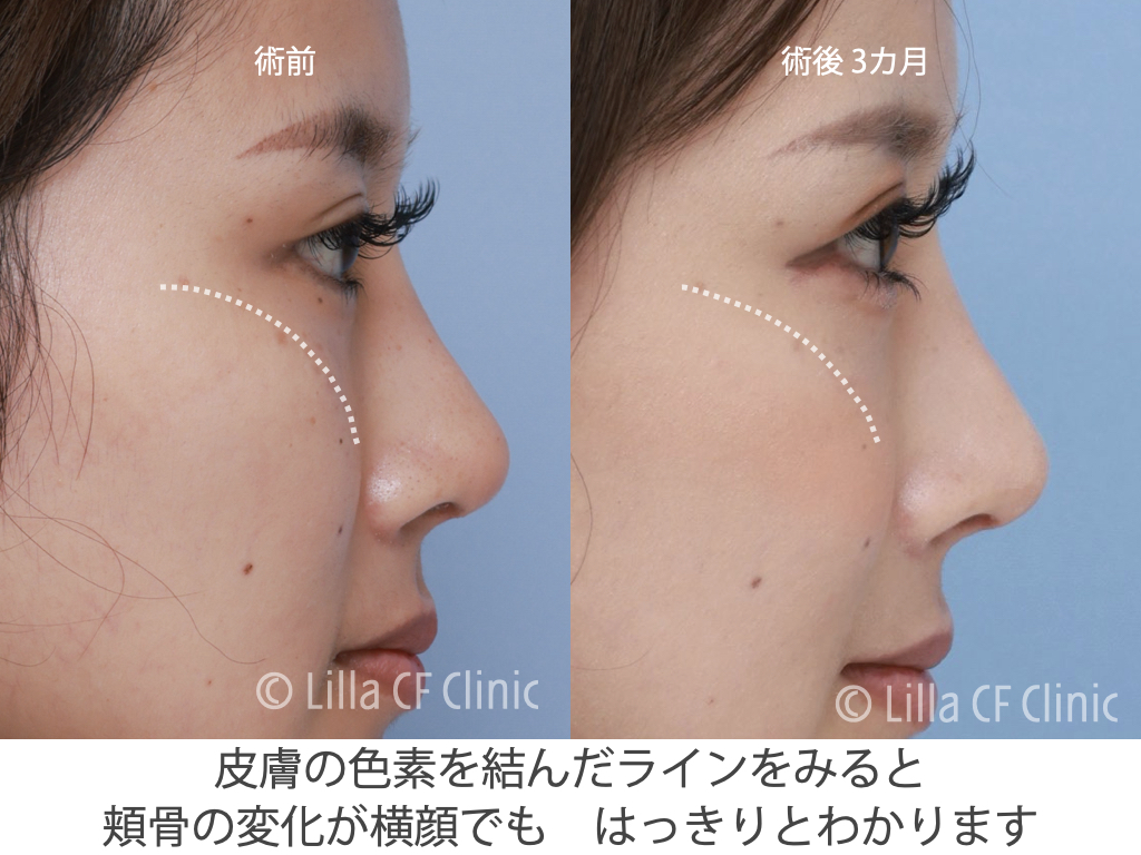 頬骨セットバックで目を大きくした症例,
