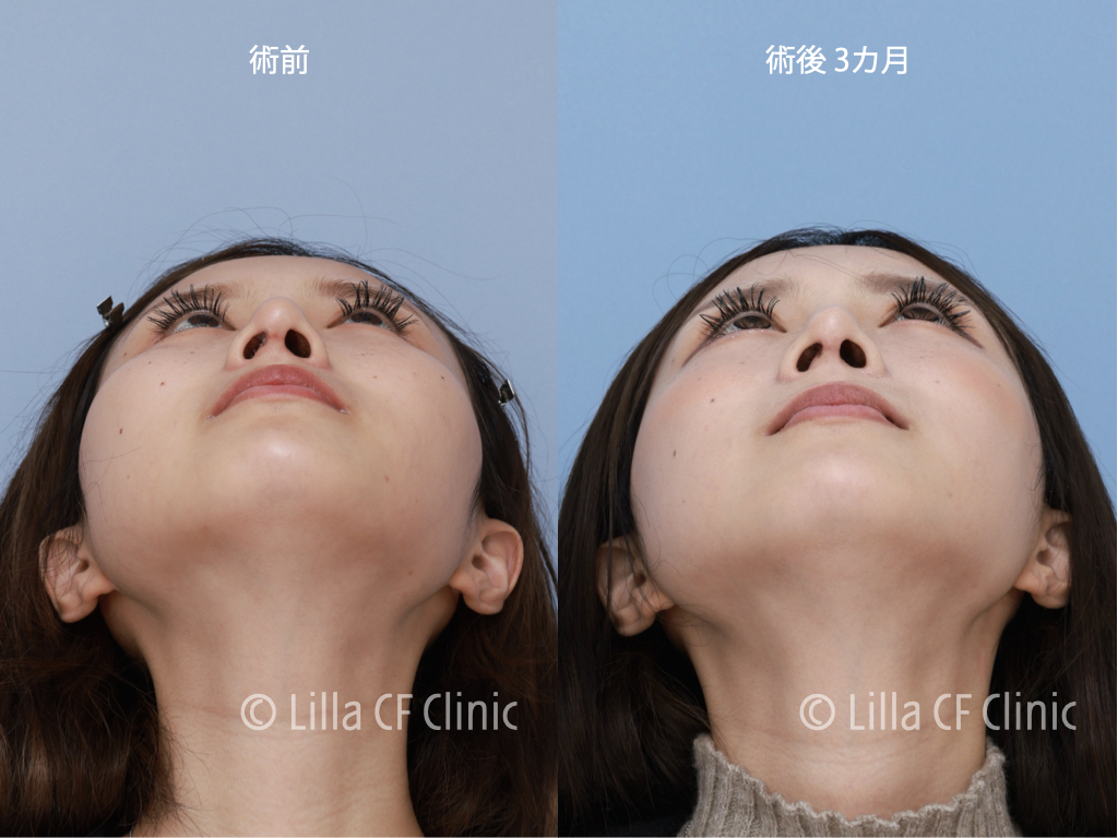 頬骨セットバックで目を大きくした症例,