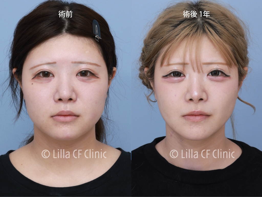 頬骨セットバック，オージーカーブ，再手術，韓国，修正