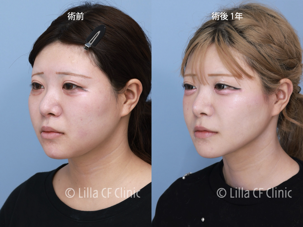 頬骨セットバック，オージーカーブ，再手術，韓国，修正