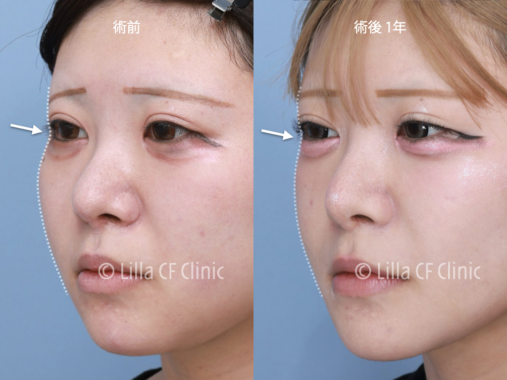 頬骨セットバック，オージーカーブ，再手術，韓国，修正