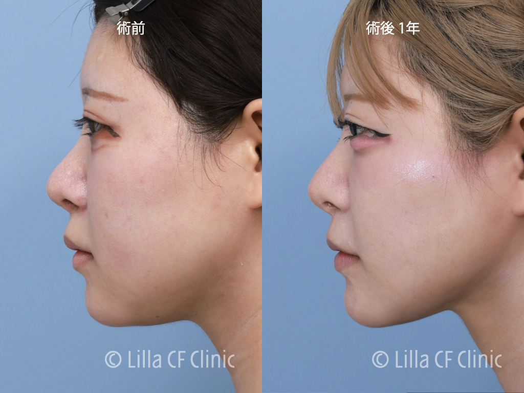 頬骨セットバック，オージーカーブ，再手術，韓国，修正