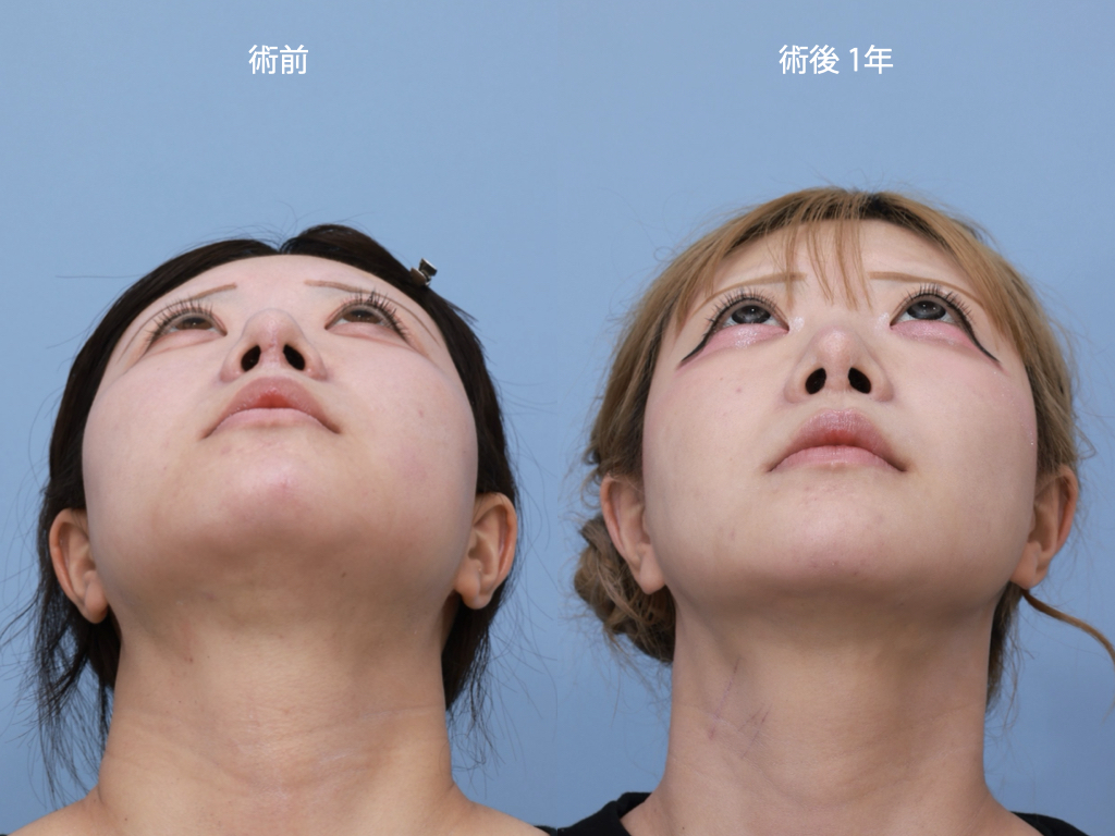 頬骨セットバック，オージーカーブ，再手術，韓国