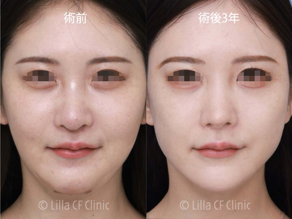 鼻中隔延長，鼻尖縮小，肋軟骨，鼻修正，長期経過