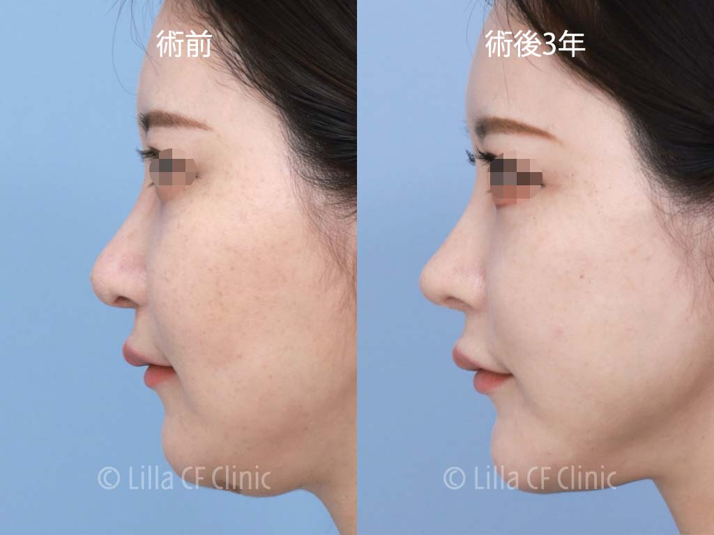 鼻中隔延長，鼻尖縮小，肋軟骨，鼻修正，長期経過