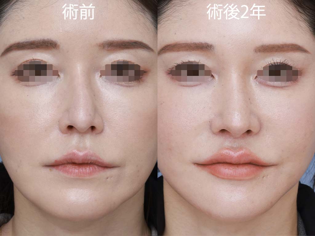 プリザベーション法，プッシュダウン，レットダウン