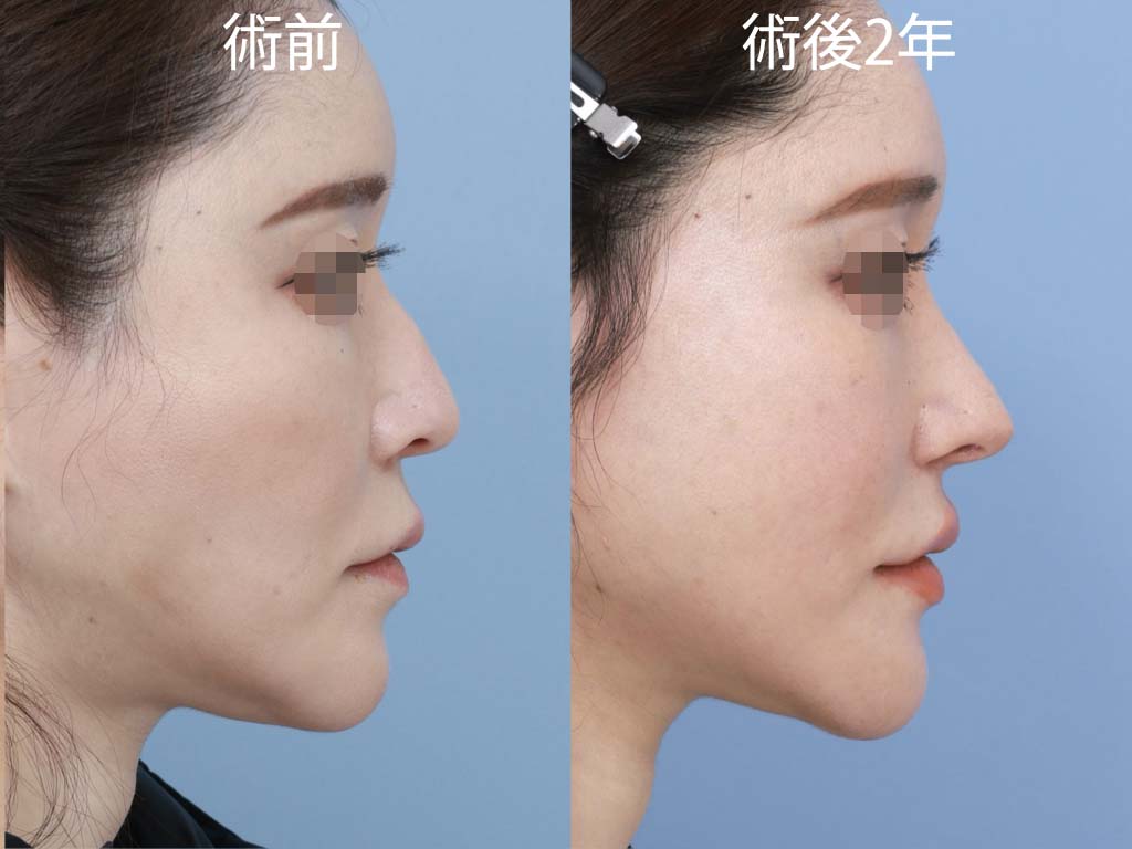 プリザベーション法，プッシュダウン，レットダウン