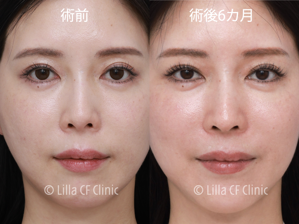 プリザベーション法，鼻尖形成，鼻中隔延長