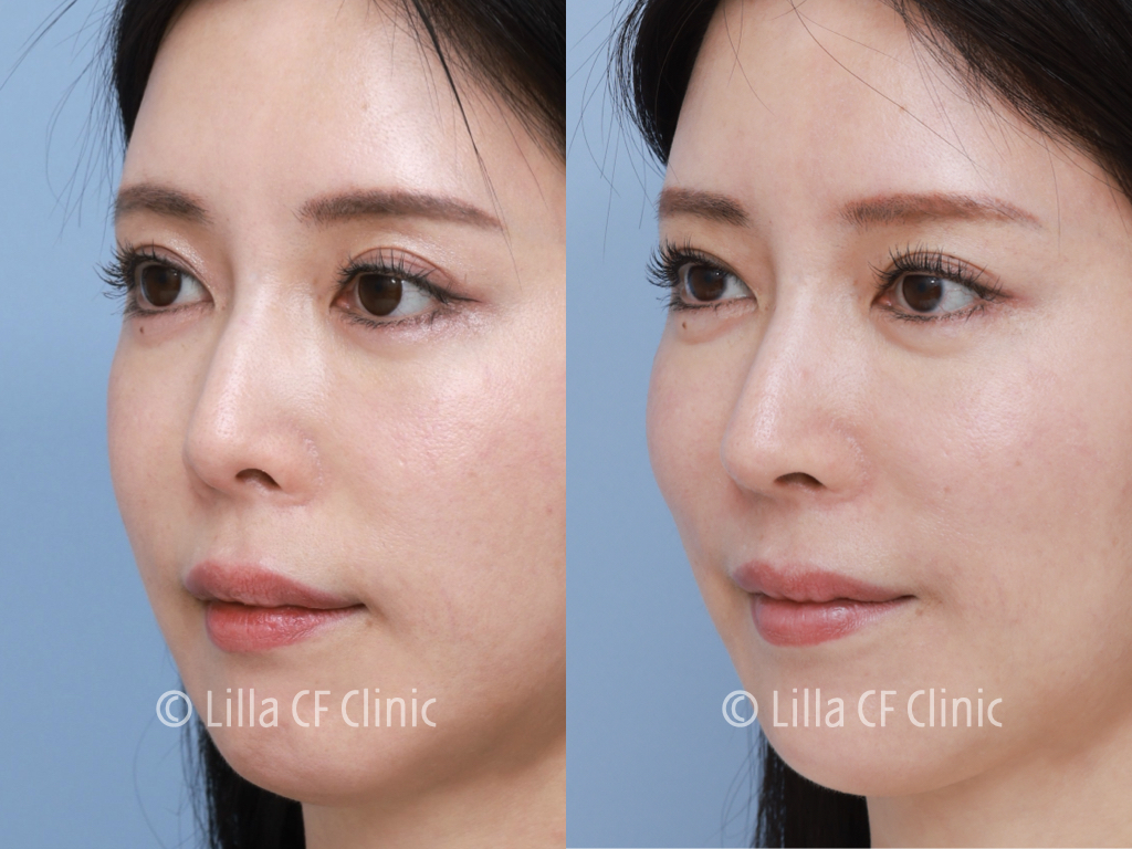 プリザベーション法，鼻尖形成，鼻中隔延長