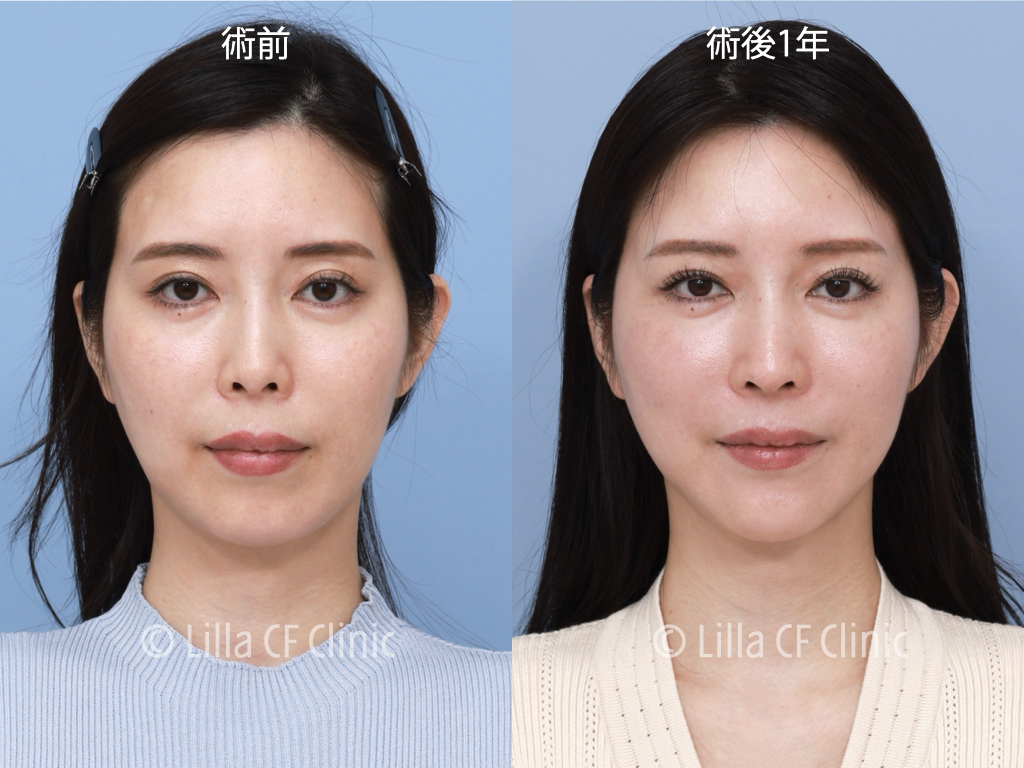 頬骨セットバック，プリザベーション法，鼻尖形成，鼻中隔延長