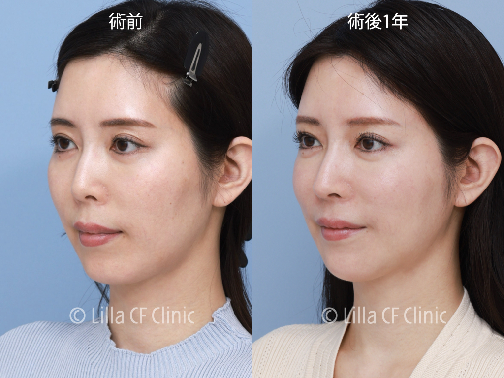 頬骨セットバック，プリザベーション法，鼻尖形成，鼻中隔延長