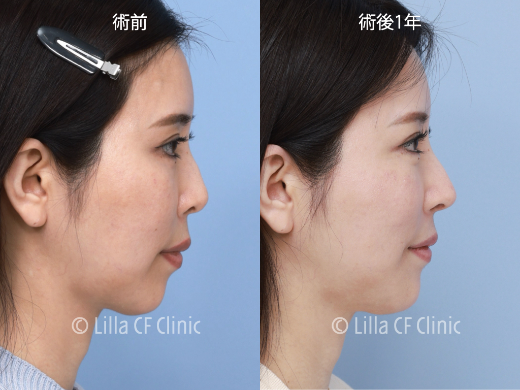 頬骨セットバック，プリザベーション法，鼻尖形成，鼻中隔延長