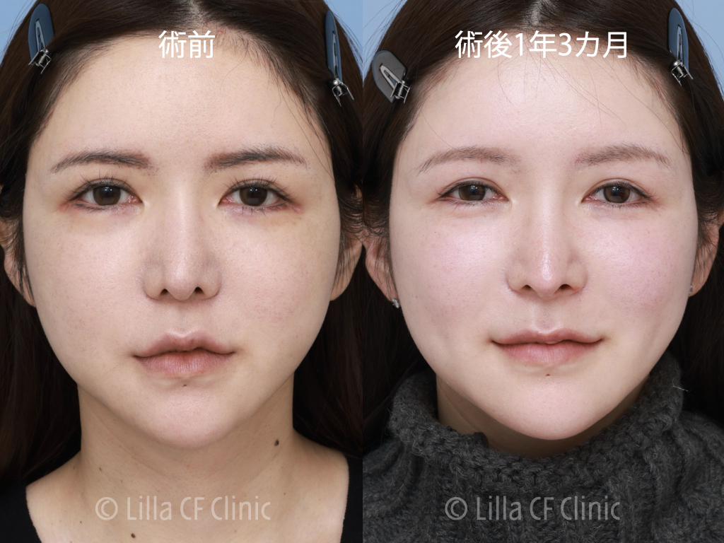 貴族手術，猫手術，肋軟骨，ピンチノーズ，修正